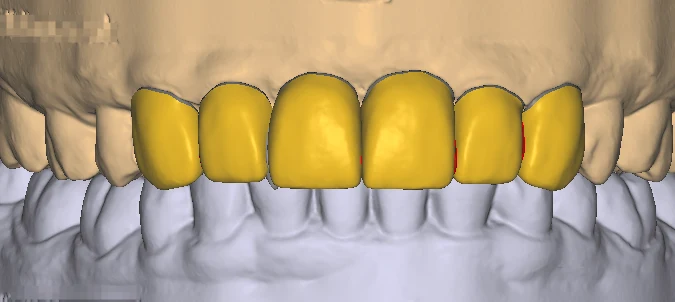 Dental CAD interface with a detailed digital restoration model