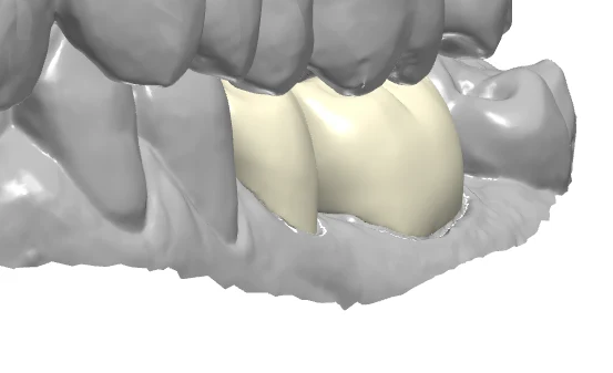 Crown restoration design shown in dental CAD software